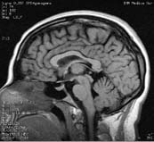 Image of a patient's brain.